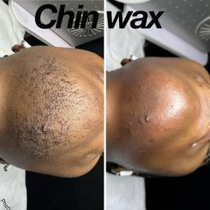 chinWax