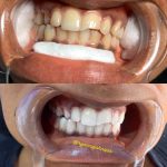 teethWhitening